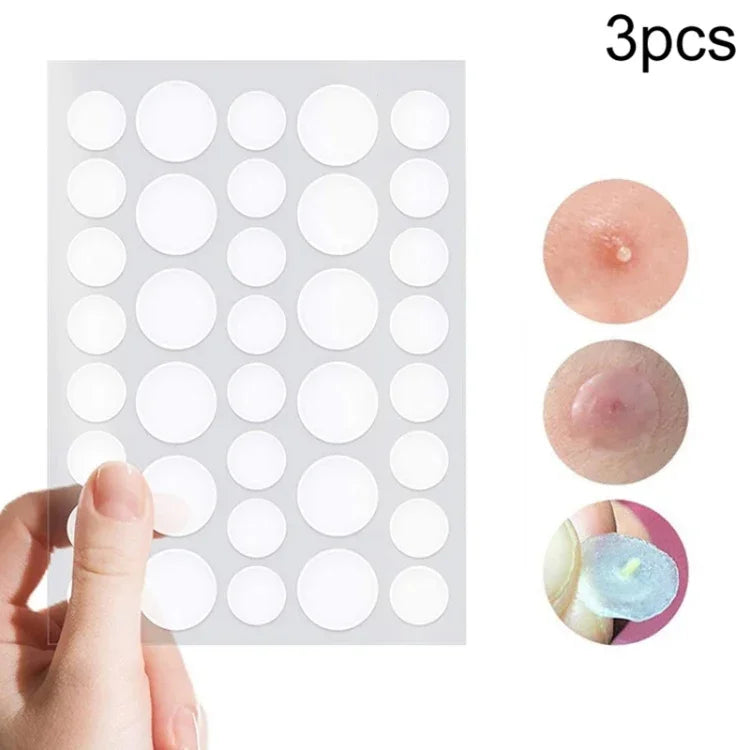 ชุดเครื่องมือรักษาสิว 3 ชิ้น สติ๊กเกอร์รอยแผลเป็นจากสิวและสิว